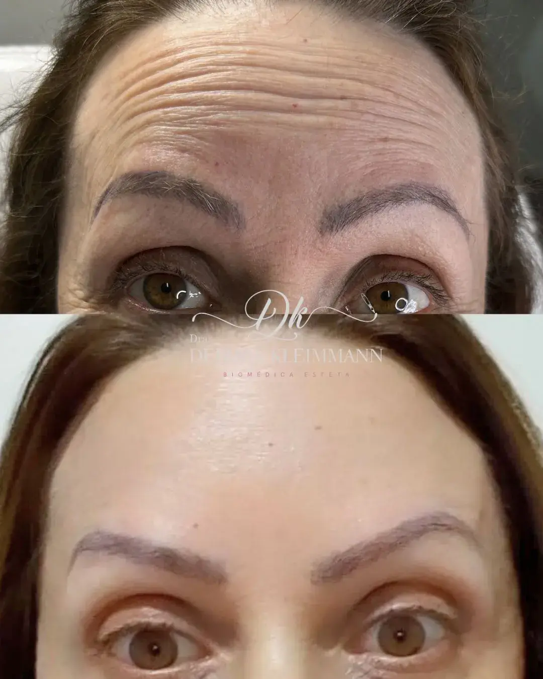 Antes e Depois do Tratamento com Botox