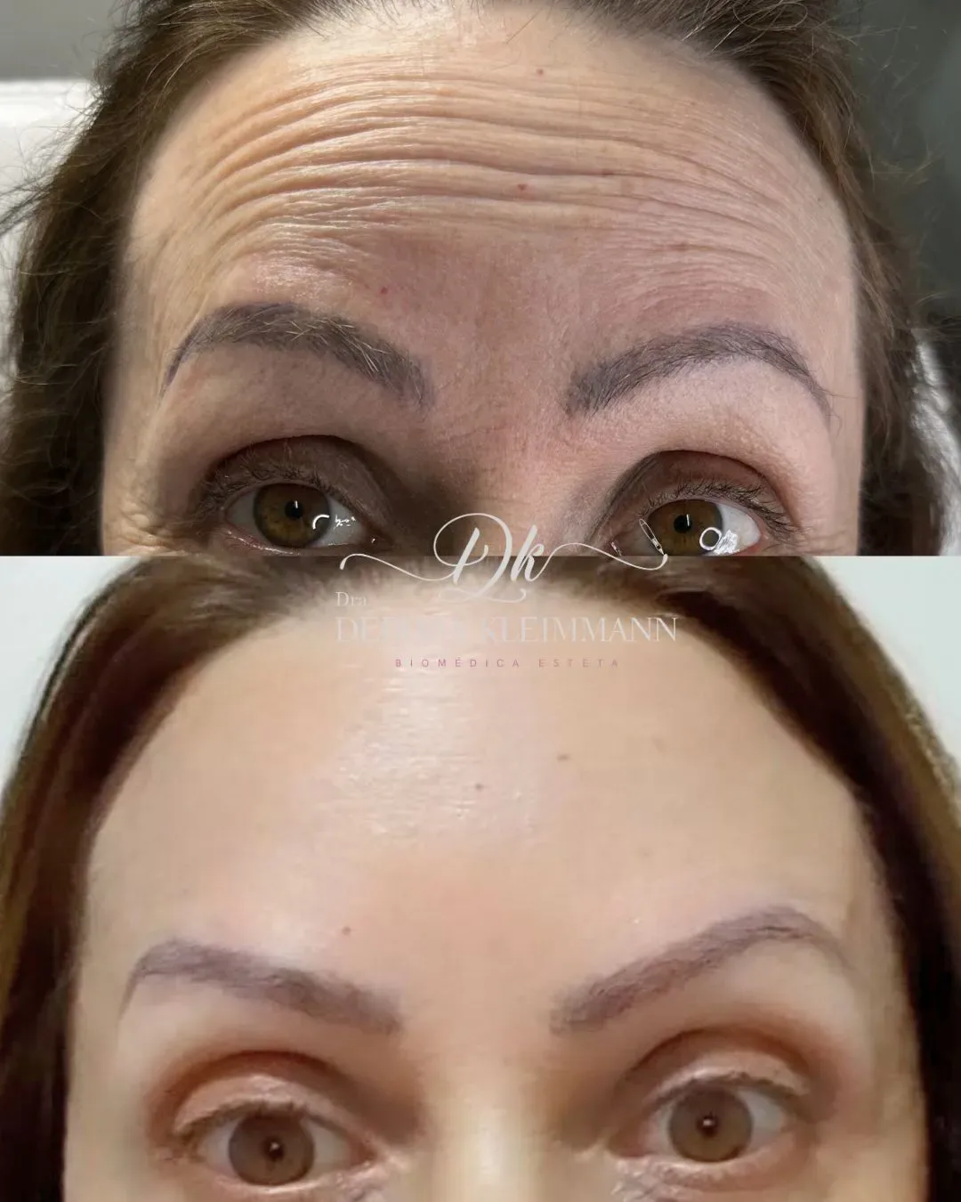 Antes e depois da aplicação de toxina botulínica