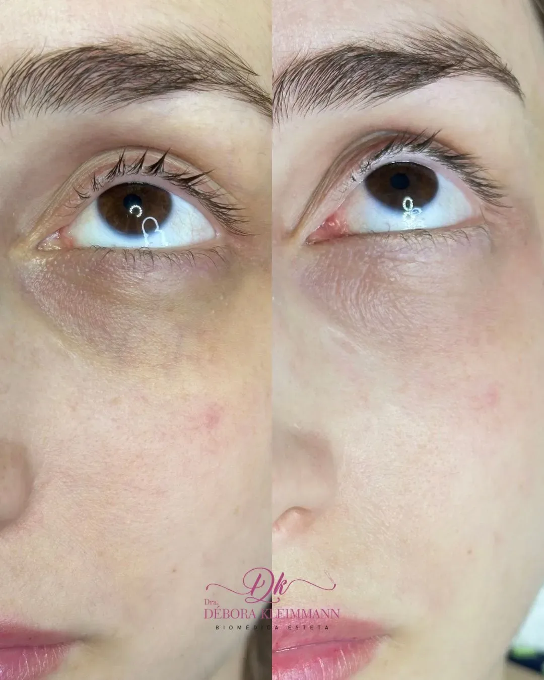 Antes e depois de camuflagem de olheiras